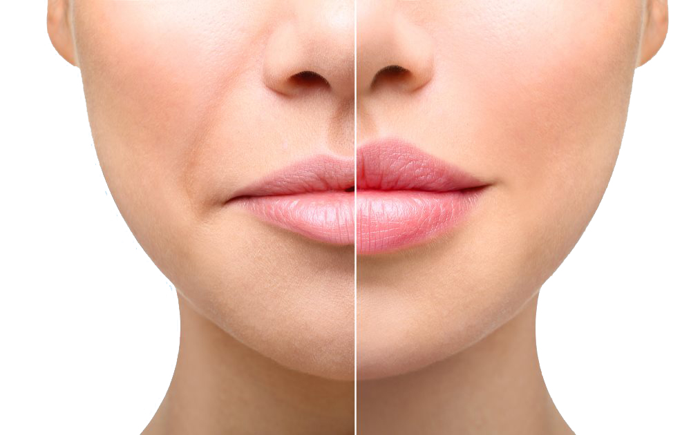 Mooie lippen starten bij goede verzorging - Praktijk voor Injectables